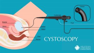 What Is a Cystoscopy? Purpose, Procedure...