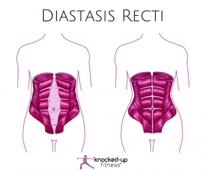 How to Check for Diastasis Recti