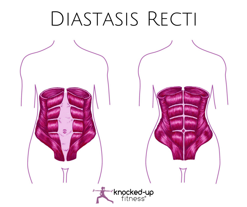 How to Check for Diastasis Recti
